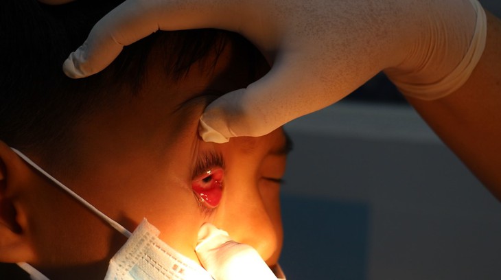 Khi bị đau mắt đỏ, cần làm gì để bệnh không lây cho người khác? - Ảnh 2.