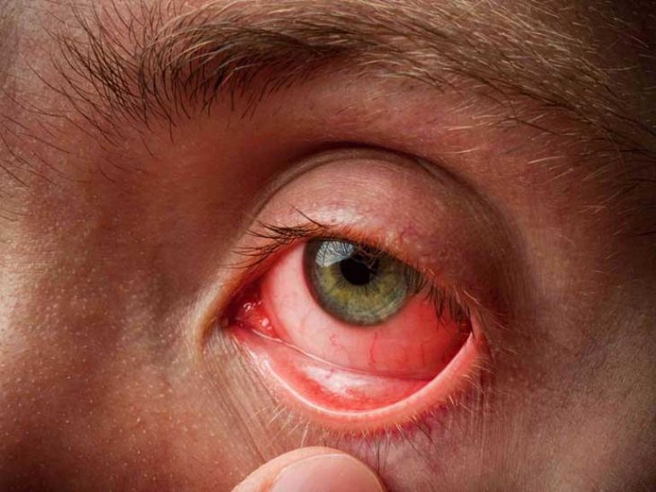 Sưng mí mắt, kèm đau nhức không chỉ là đau mắt đỏ mà còn do bệnh lý nào? - Ảnh 1.