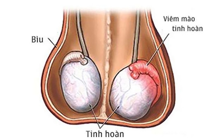 Những điều nam giới cần lưu ý về bệnh viêm mào tinh hoàn, tránh biến chứng vô sinh - Ảnh 2. Những điều nam giới cần lưu ý về bệnh viêm mào tinh hoàn, tránh biến chứng vô sinh - Ảnh 2.