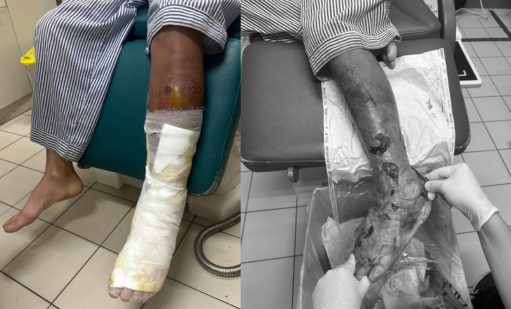 Người đàn ông phát hiện bị đái tháo đường type 2 sau khi nhiễm trùng toàn bộ cẳng chân - Ảnh 2. Người đàn ông phát hiện bị đái tháo đường type 2 sau khi nhiễm trùng toàn bộ cẳng chân - Ảnh 2.