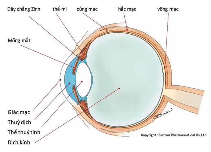 Bé 6 tuổi đi khám cận thị, không ngờ mắc lệch thủy tinh thể , cha mẹ cần biết căn bệnh này - Ảnh 1.