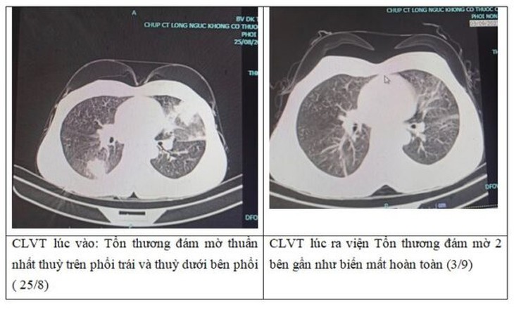 Phim chụp cắt lớp vi tính của người bệnh viêm phổi. Phim chụp cắt lớp vi tính của người bệnh viêm phổi.