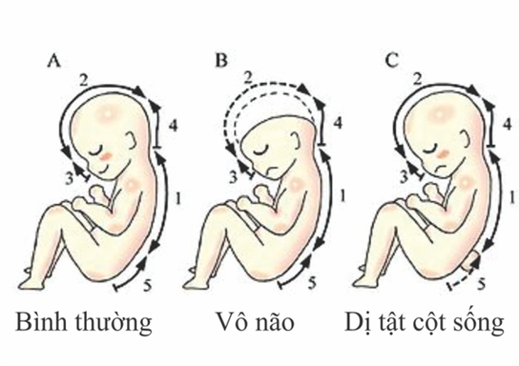 Tầm quan trọng của Axit folic trong phòng chống dị tật thai nhi - Ảnh 1.