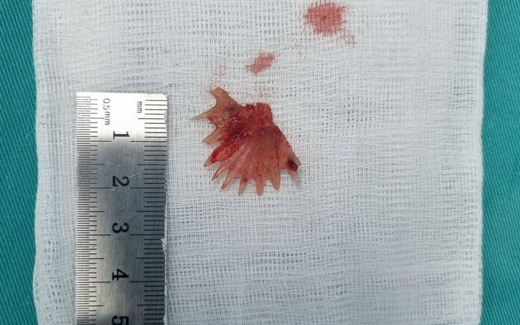 Bị hóc xương cá hình răng cưa hơn 2cm ở thực quản