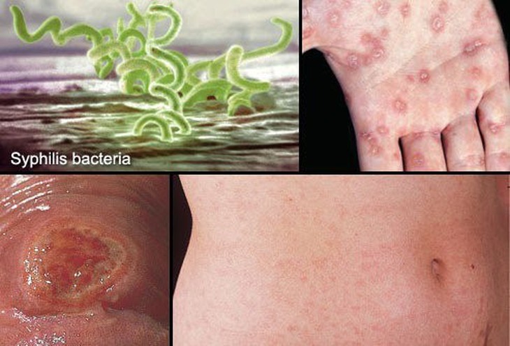 Nguy cơ nhiễm HIV ở người mắc các bệnh lây qua đường dục - Ảnh 1. Nguy cơ nhiễm HIV ở người mắc các bệnh lây qua đường dục - Ảnh 1.
