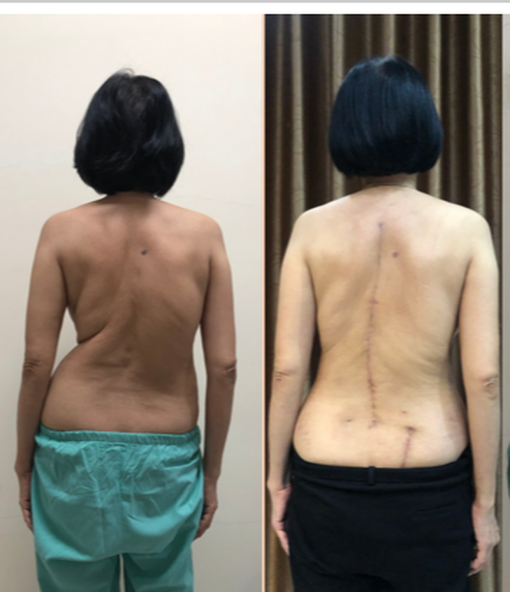 Người phụ nữ 59 tuổi cao hơn 5 cm nhờ nắn chỉnh vẹo sống - Ảnh 1.