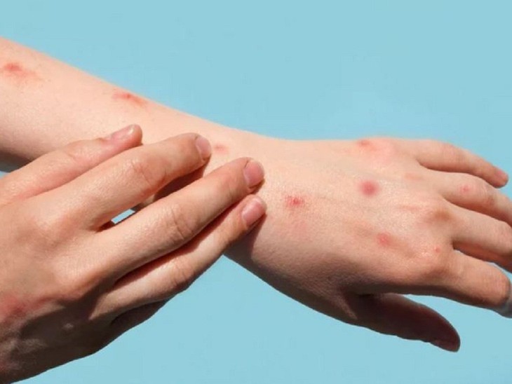 Ghi nhận 2 ca đậu mùa khỉ, Bộ Y tế yêu cầu tăng cường giám sát, điều trị, không để lây nhiễm chéo - Ảnh 1.