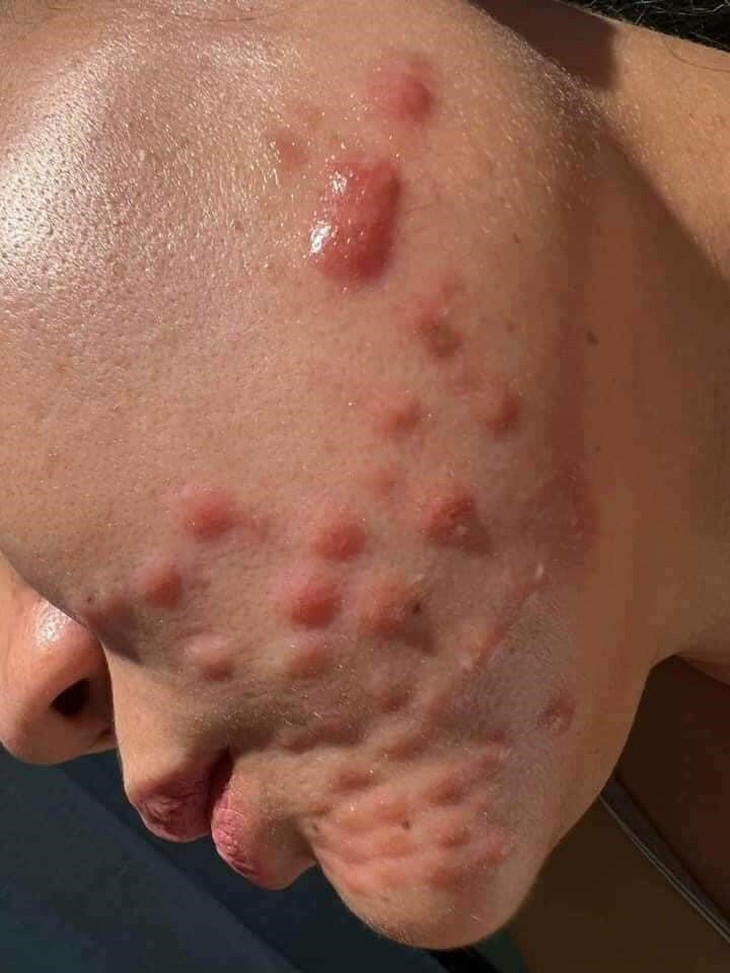 Nhiều trường hợp dị ứng, biến chứng vì tiêm Meso Exosome chưa được cấp phép - Ảnh 3. Nhiều trường hợp dị ứng, biến chứng vì tiêm Meso Exosome chưa được cấp phép - Ảnh 3.