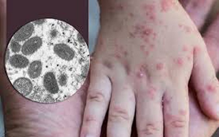 Ghi nhận 2 ca đậu mùa khỉ, Bộ Y tế yêu cầu tăng cường giám sát, điều trị, không để lây nhiễm chéo