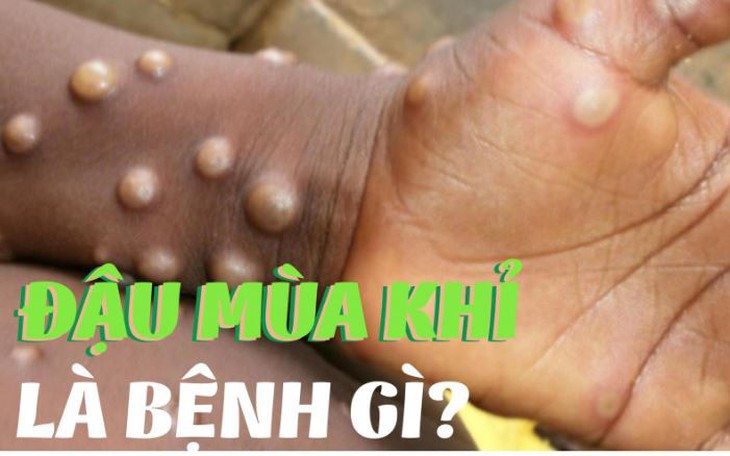 Từ 2 ca đậu mùa khỉ mới phát hiện, cần biết 4 điều sau để giảm nguy cơ lây nhiễm