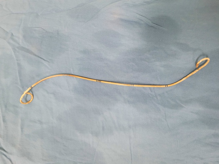 Ống Sonde JJ bị cụ bà bỏ quên 4 năm trong cơ thể - Ảnh 3. Ống Sonde JJ bị cụ bà bỏ quên 4 năm trong cơ thể - Ảnh 3.