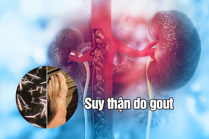 Suy thận do gout - Những điều bạn cần biết - Ảnh 1.