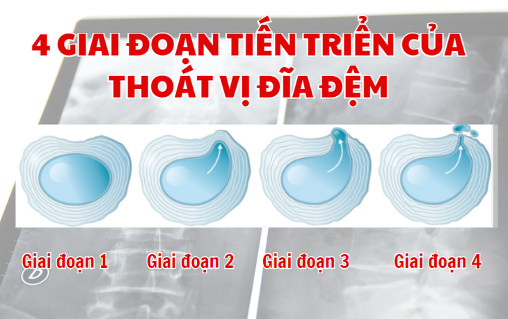 Thoát vị đĩa đệm cột sống thắt lưng có chữa khỏi được không? - Ảnh 1.
