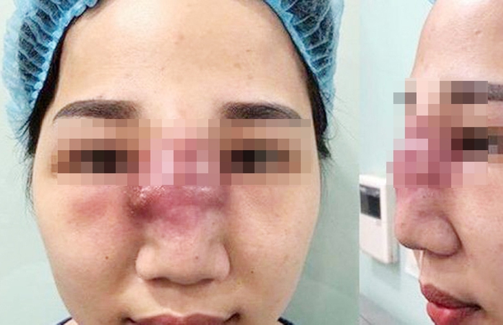 2 người phụ nữ bị biến chứng và bị trộm hết tài sản sau khi được đưa vào khách sạn tiêm filler 'chui' - Ảnh 1.