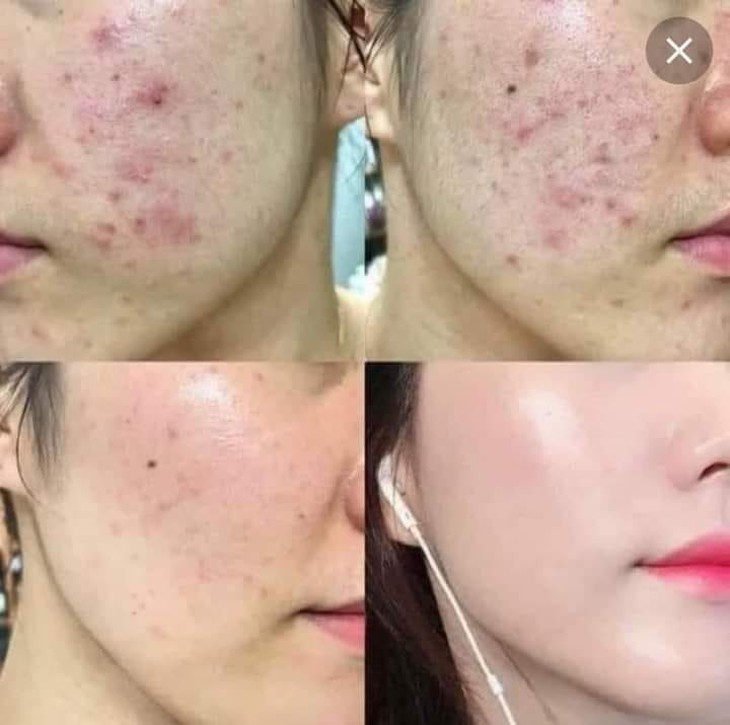 Thuốc bôi điều trị mụn trứng cá hiệu quả - Ảnh 1.