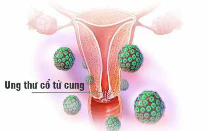 Ung thư cổ tử cung dễ "tấn công" ai?