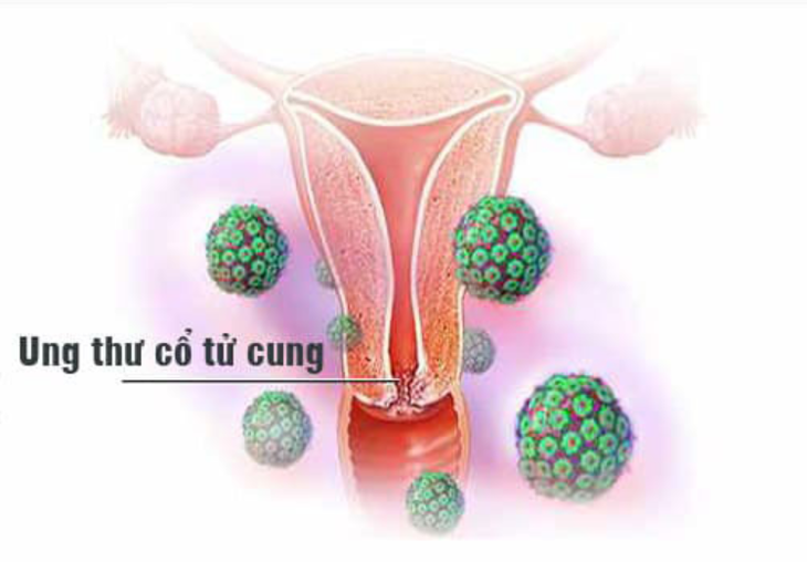 Câu hỏi thường gặp liên quan đến ung thư cổ tử cung- Ảnh 1. Câu hỏi thường gặp liên quan đến ung thư cổ tử cung- Ảnh 1.