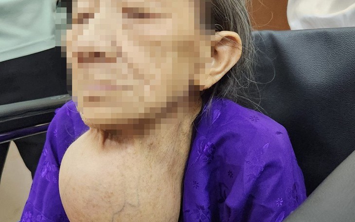 Cắt bỏ bướu giáp khổng lồ đeo bám 40 năm cho cụ bà 92 tuổi