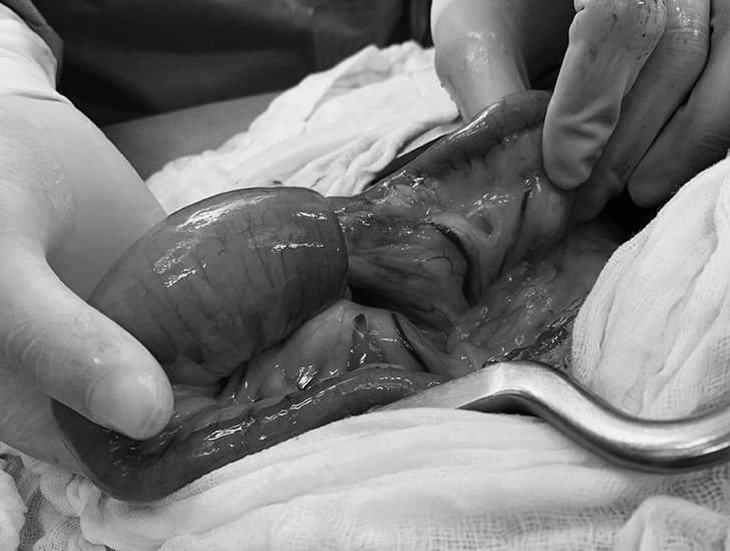 Trẻ đau bụng từng cơn cảnh giác với bệnh lồng ruột cấp - Ảnh 1.