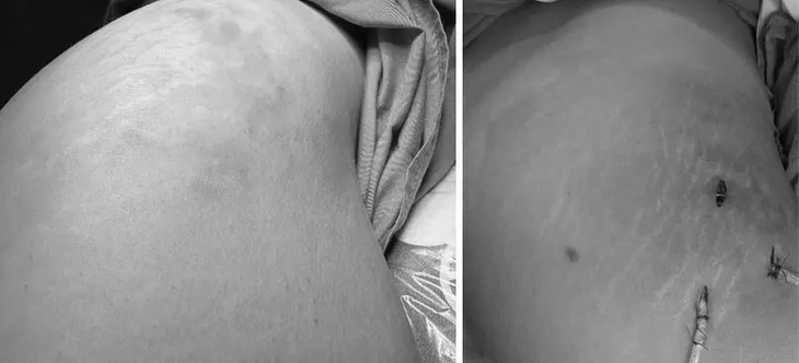 Vòng 3 biến thành ổ mủ sau 4 năm tiêm filler tăng kích thước- Ảnh 1. Vòng 3 biến thành ổ mủ sau 4 năm tiêm filler tăng kích thước- Ảnh 1.