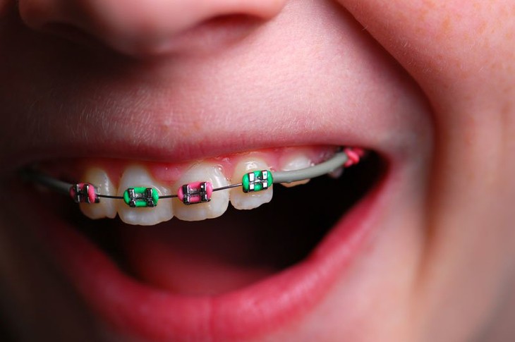 Độ tuổi nào phù hợp nhất để chỉnh nha?- Ảnh 1.