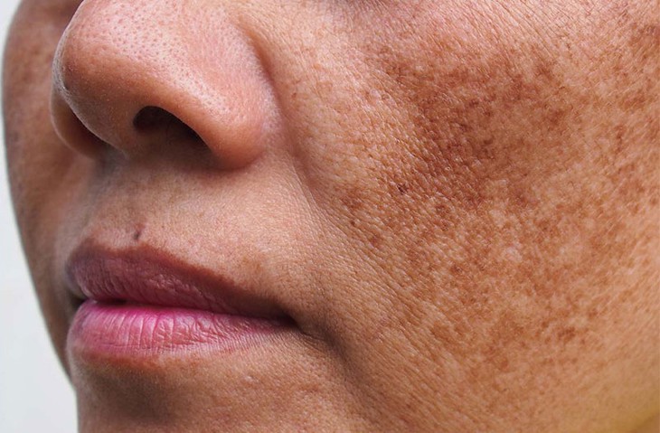 Nám tàn nhang là sự tăng sinh quá mức và không phân bố đều của melanin.