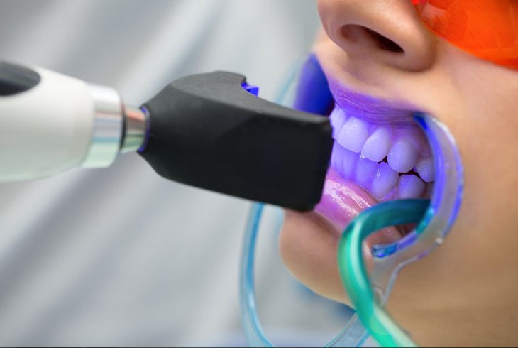 Tẩy trắng răng và những điều cần lưu ý- Ảnh 2.