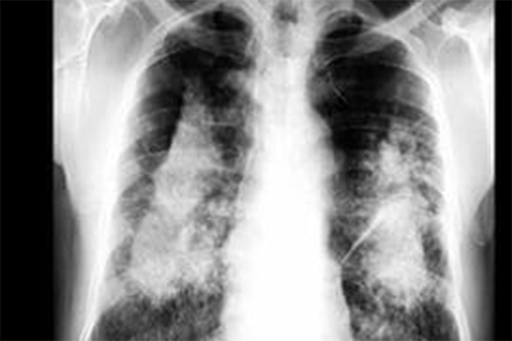Người lao động làm các nghề, công việc sau đây có nguy cơ mắc bệnh: sản xuất gốm sứ, giấy, chất đèo, sơn, cao su, mỹ phẩm, dược phẩm và các nghề, công việc khác có tiếp xúc với bụi talc. Ảnh minh họa