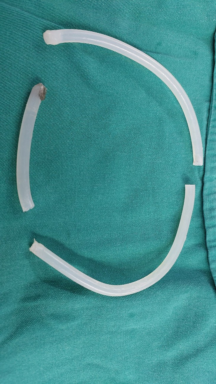 Sau uống rượu, người đàn ông nhét keo nến dài 40cm vào 'cậu nhỏ' để tạo khoái cảm- Ảnh 2. Sau uống rượu, người đàn ông nhét keo nến dài 40cm vào 'cậu nhỏ' để tạo khoái cảm- Ảnh 2.