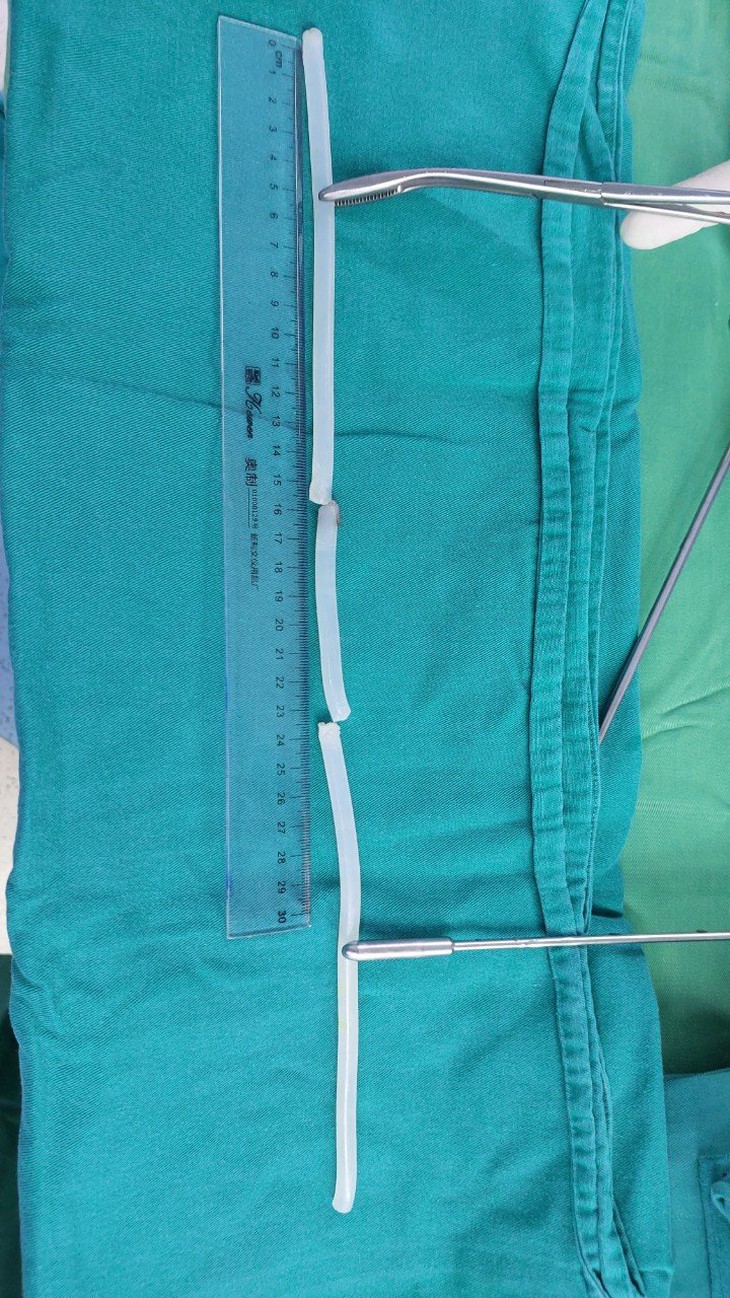 Sau uống rượu, người đàn ông nhét keo nến dài 40cm vào 'cậu nhỏ' để tạo khoái cảm- Ảnh 3. Sau uống rượu, người đàn ông nhét keo nến dài 40cm vào 'cậu nhỏ' để tạo khoái cảm- Ảnh 3.