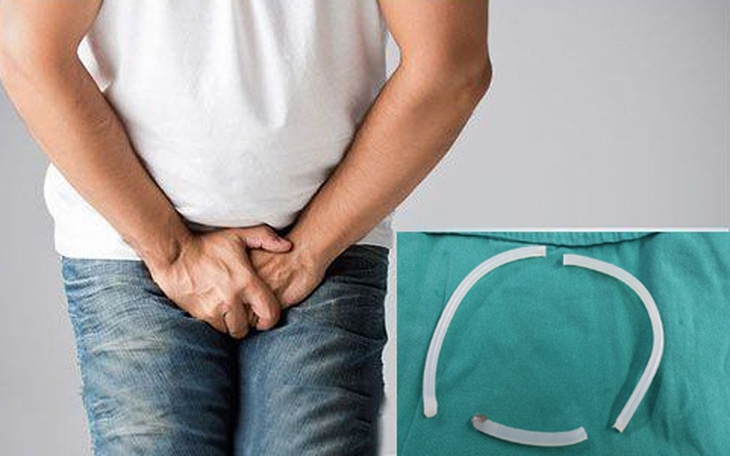 Người đàn ông nhét keo nến dài 40cm vào "cậu nhỏ" để tạo khoái cảm