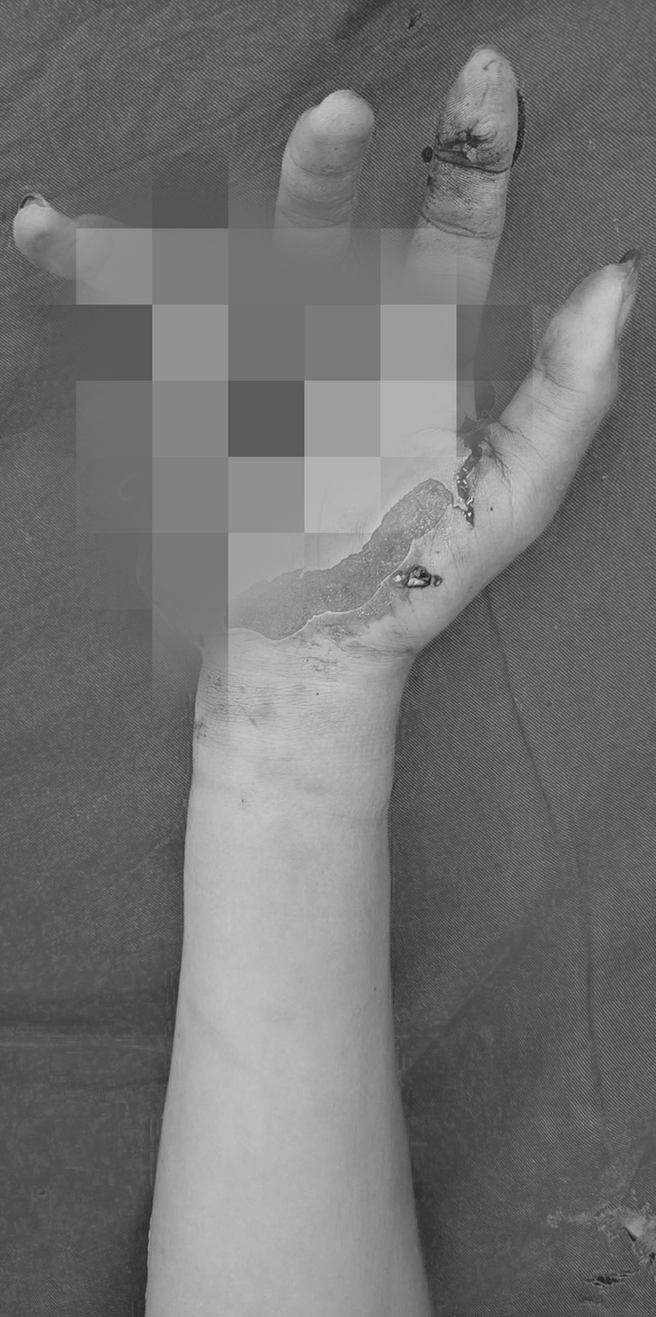 'Chơi' pháo tự chế, nhiều người phải mổ cấp cứu vì chấn thương nghiêm trọng- Ảnh 1. 'Chơi' pháo tự chế, nhiều người phải mổ cấp cứu vì chấn thương nghiêm trọng- Ảnh 1.