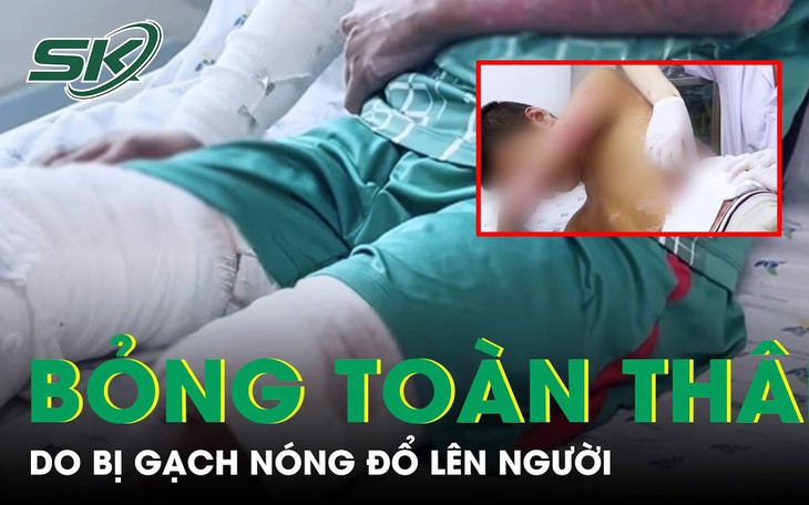 Gạch nóng đổ lên người khiến bé trai bỏng nặng