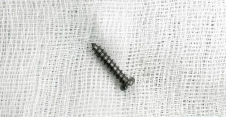 Gắp đinh vít dài 2cm trong ruột non bệnh nhi 28 tháng - Ảnh 2.