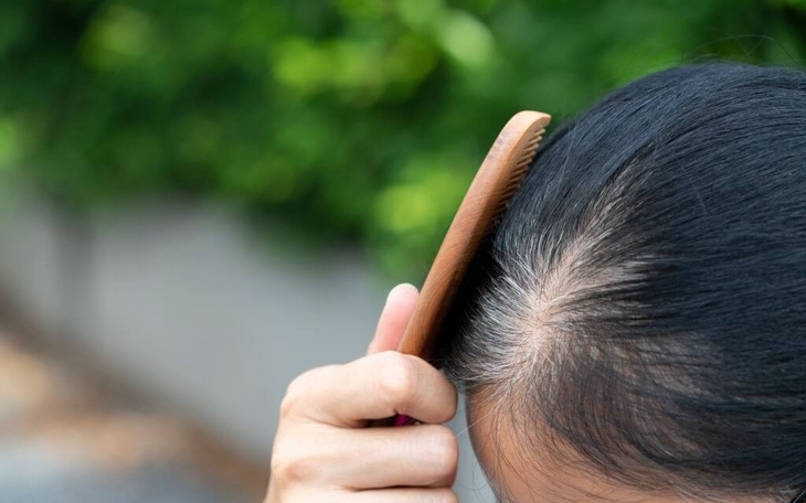 Vì sao người trẻ tóc bạc sớm?