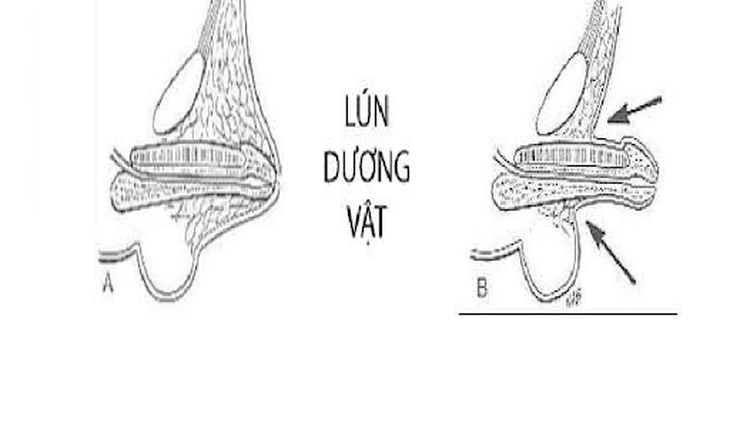 Vùi dương vật bẩm sinh là do thiếu hụt bẩm sinh chiều cao của ống da dương vật.