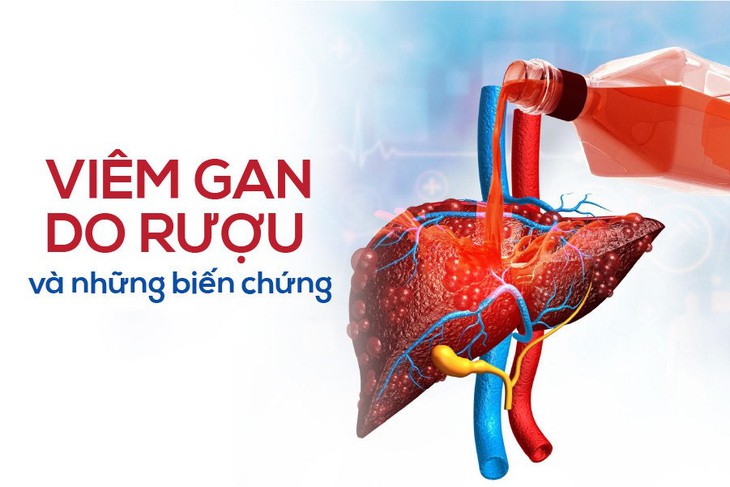 Viêm gan do rượu, bia và sản phẩm hỗ trợ bồi bổ gan- Ảnh 1.