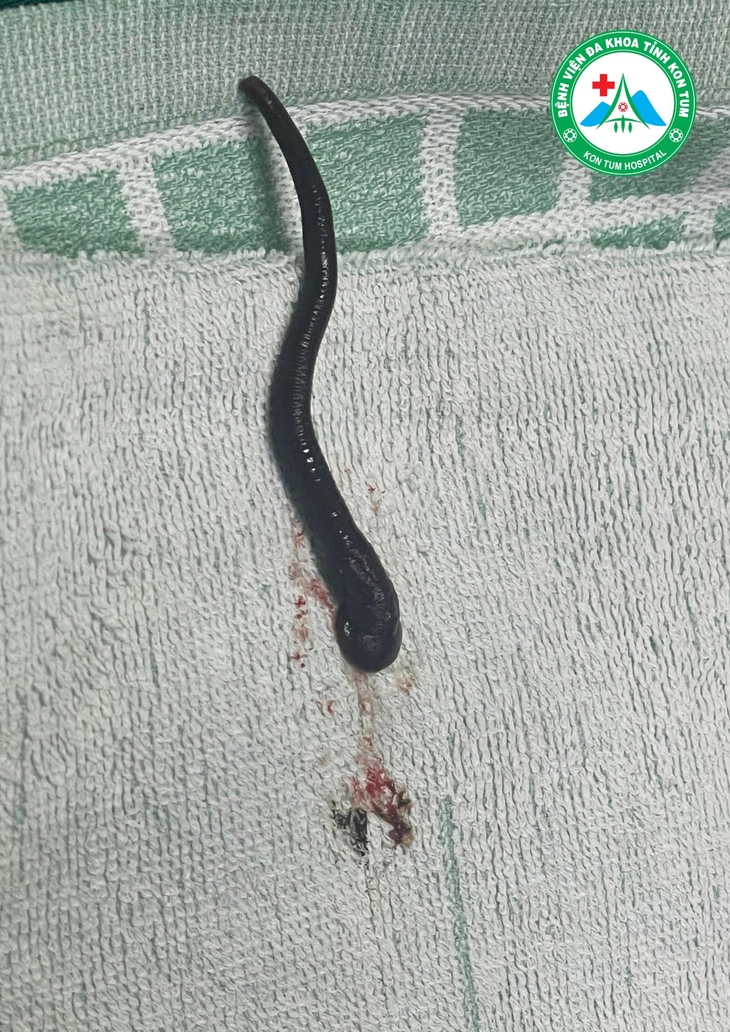 Chảy máu cam không rõ nguyên nhân, phát hiện vắt dài gần 7cm sống trong xoang mũi- Ảnh 2. Chảy máu cam không rõ nguyên nhân, phát hiện vắt dài gần 7cm sống trong xoang mũi- Ảnh 2.