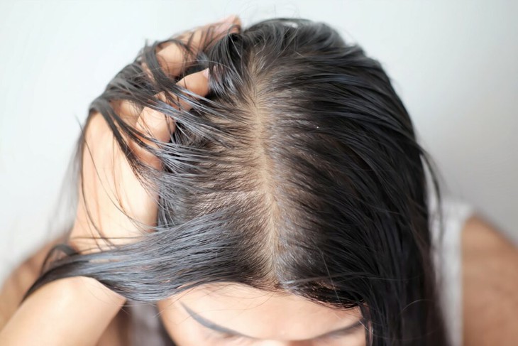 Tóc bết da dầu làm thế nào khắc phục?- Ảnh 1.