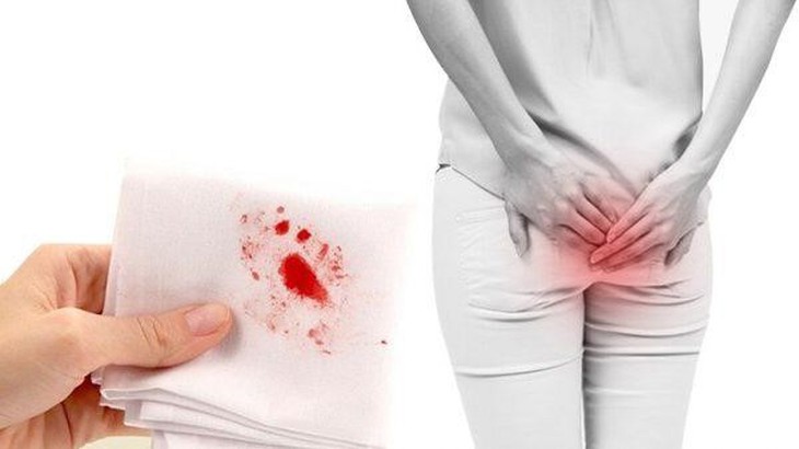 Trong uống, ngoài bôi – Giải pháp toàn diện hỗ trợ giảm triệu chứng bệnh trĩ- Ảnh 1. Trong uống, ngoài bôi – Giải pháp toàn diện hỗ trợ giảm triệu chứng bệnh trĩ- Ảnh 1.
