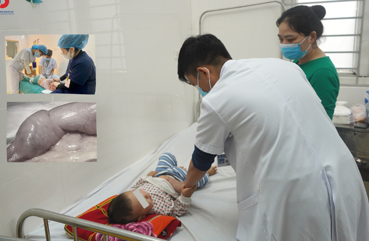 Gia tăng tình trạng trẻ bị lồng ruột, các bác sĩ khuyến cáo gì?- Ảnh 1. Gia tăng tình trạng trẻ bị lồng ruột, các bác sĩ khuyến cáo gì?- Ảnh 1.