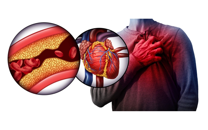 Uống mấy ly rượu mỗi ngày có thể tăng nguy cơ đột quỵ nghiêm trọng?- Ảnh 4.