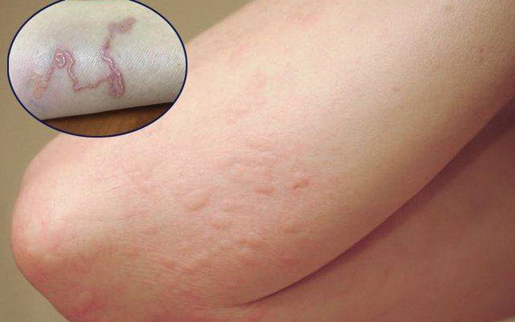 7 dấu hiệu nhiễm sán chó ở người không thể bỏ qua