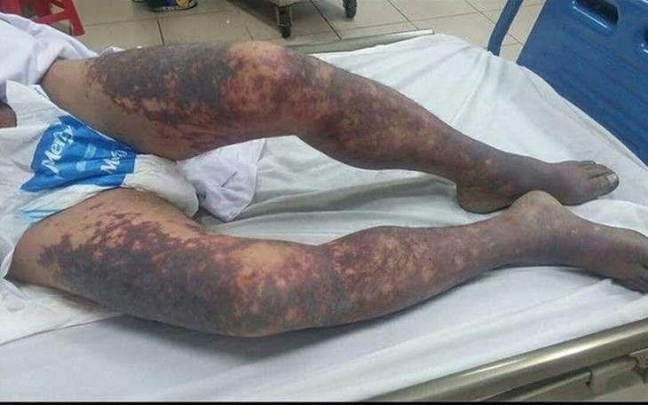 Ăn tiết canh liên hoan tất niên, một bệnh nhân tử vong do nhiễm liên cầu lợn