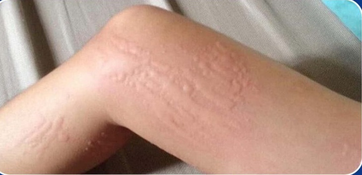 Nổi mề đay do lạnh cần làm gì?- Ảnh 1. Nổi mề đay do lạnh cần làm gì?- Ảnh 1.