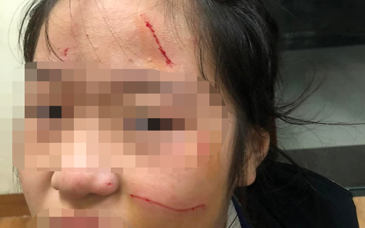 Nữ sinh lớp 6 bị bạn đánh, "dùng dao rọc giấy rạch lên mặt", nhà trường nói gì?