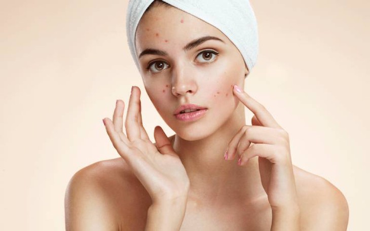 Những thực phẩm cải thiện làn da mụn trứng cá- Ảnh 1.