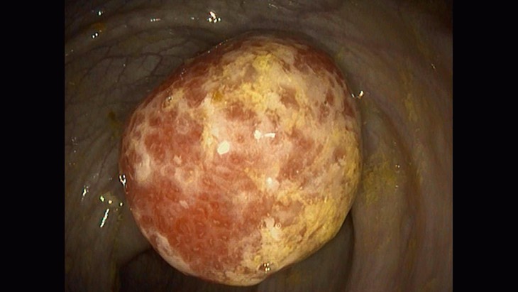 Đau bụng dữ dội từng cơn, phát hiện polyp lớn trong lòng đại tràng - Ảnh 1.