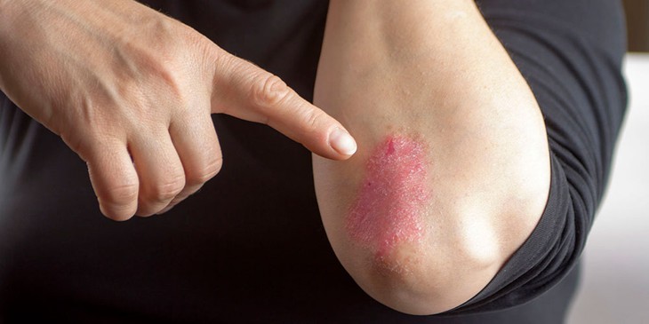 Liệu pháp giảm đau, viêm cho người bệnh viêm khớp vẩy nến- Ảnh 2. Liệu pháp giảm đau, viêm cho người bệnh viêm khớp vẩy nến- Ảnh 2.