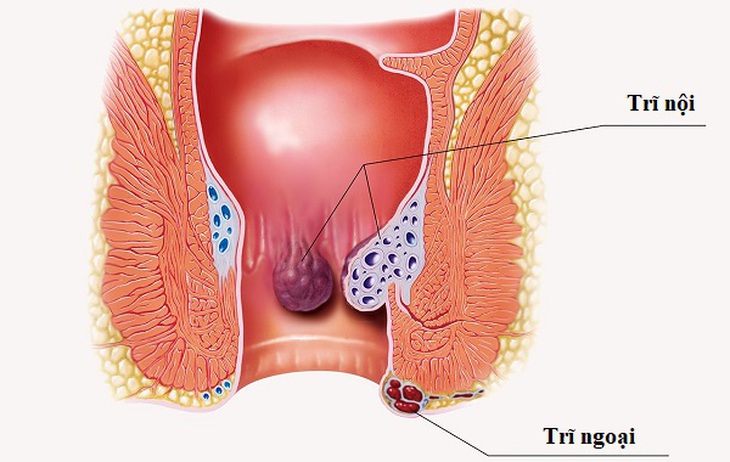 Bệnh trĩ nội có mấy cấp độ?- Ảnh 1.